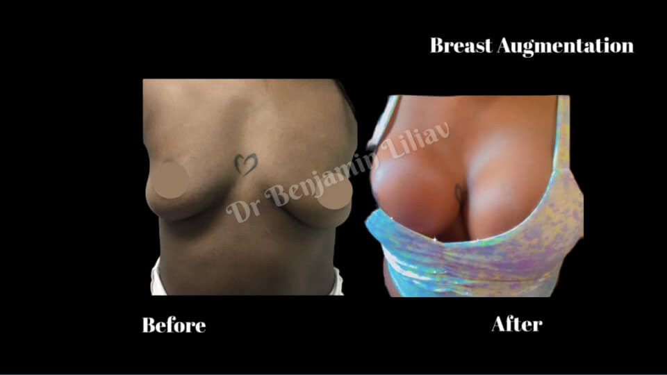 Case--2005 | Before and After Breast Augmentation