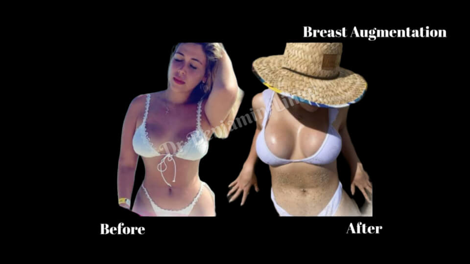 Case--6962 | Before and After Breast Augmentation