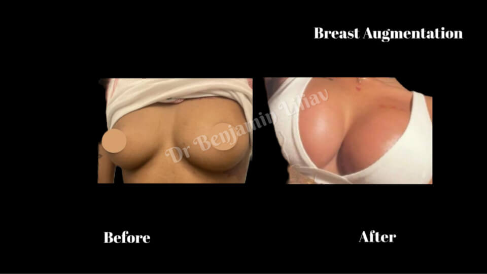 Case--9775 | Before and After Breast Augmentation