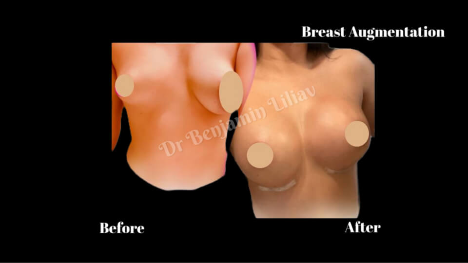 Case--5137 | Before and After Breast Augmentation