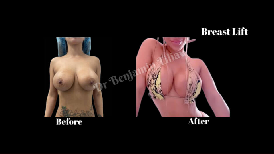 Case--4152 | Before and After Breast
