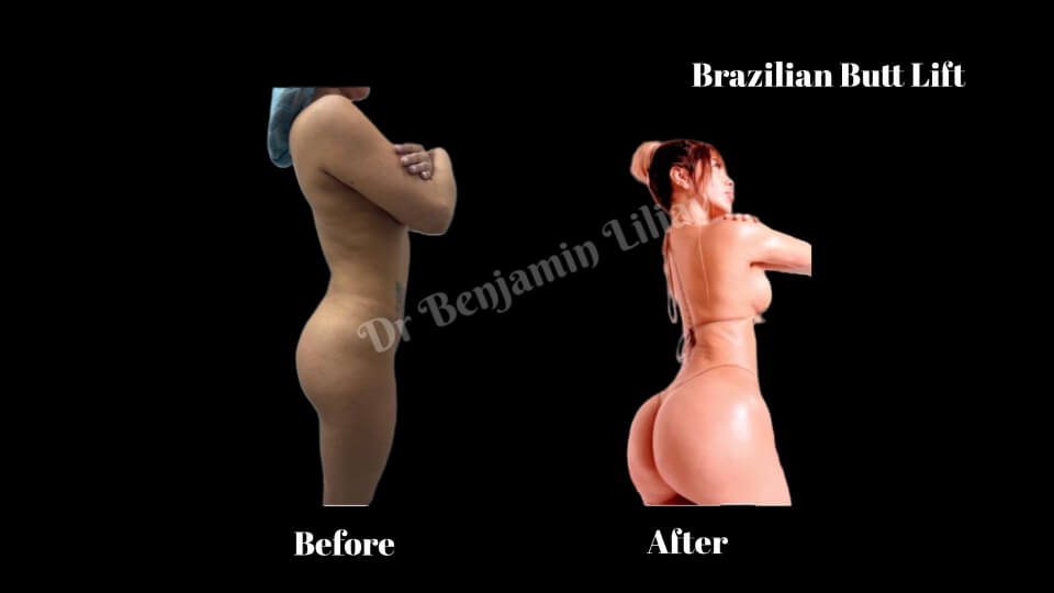 Case--4299 | Before and After BBL