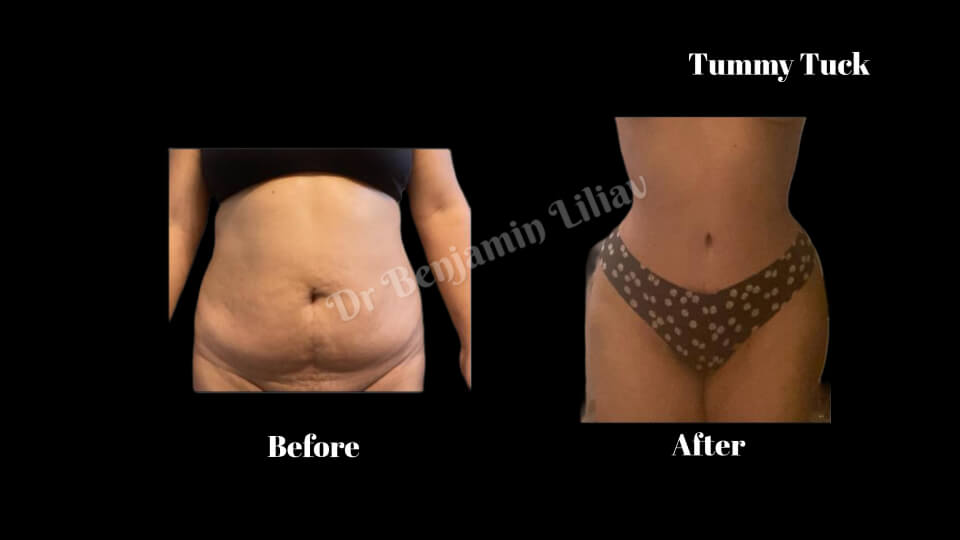 Case--7043 | Before and After Tummy Tuck