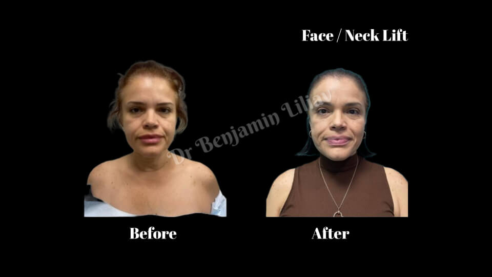 Case--2067 | Before and After Face