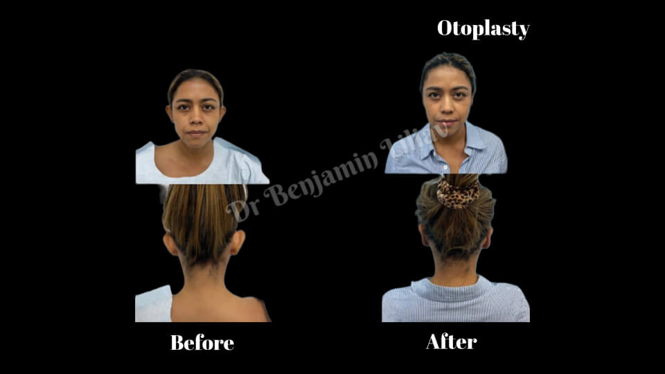 Case--3902 | Before and After Otoplasty