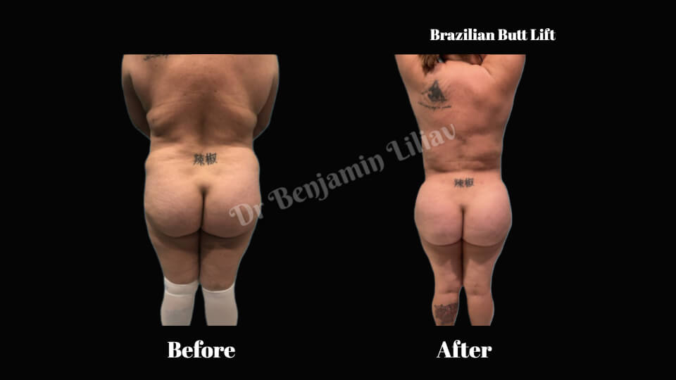 Case--5962 | Before and After BBL