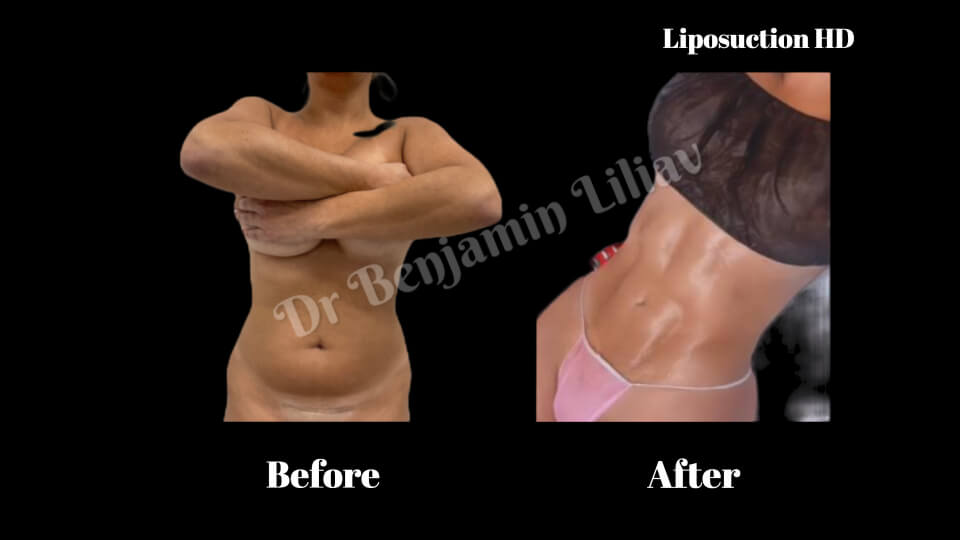 Case--3826 | Before and After Liposuction HD