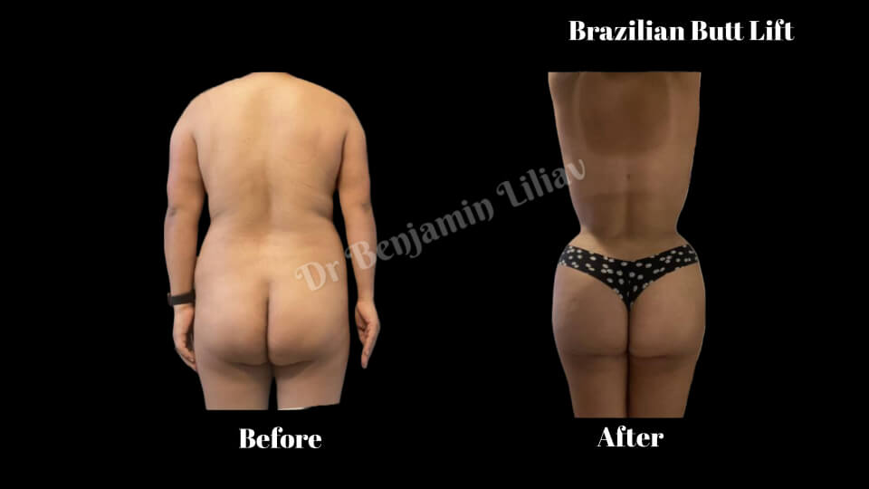 Case--2148 | Before and After BBL