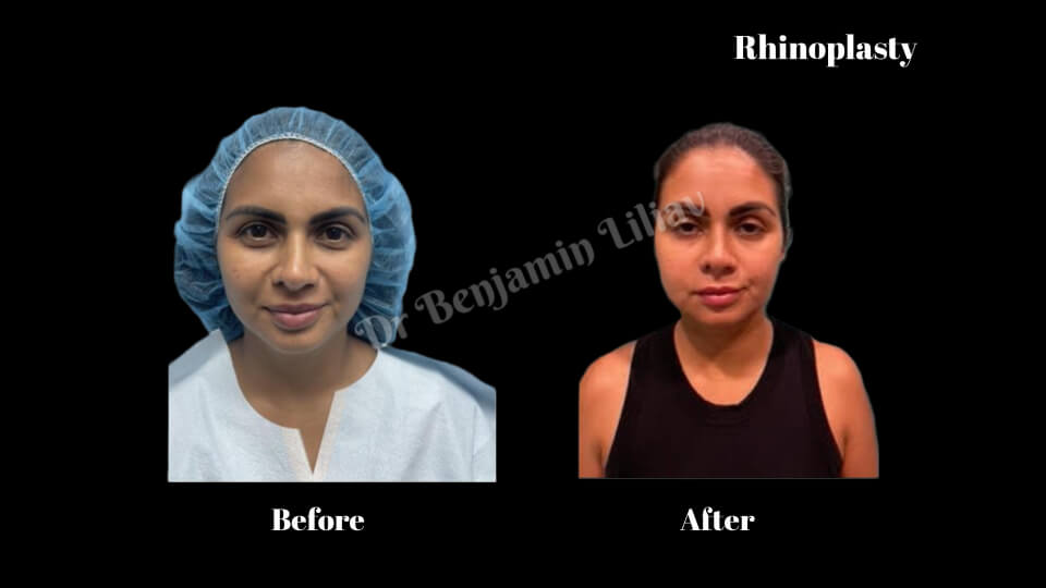 Case--1017 | Before and After Rhinoplasty