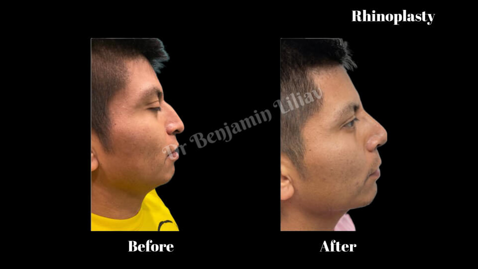 Case--6488 | Before and After Rhinoplasty