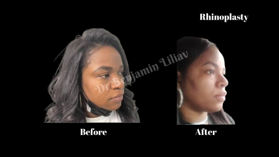 Case--6457 | Before and After Rhinoplasty
