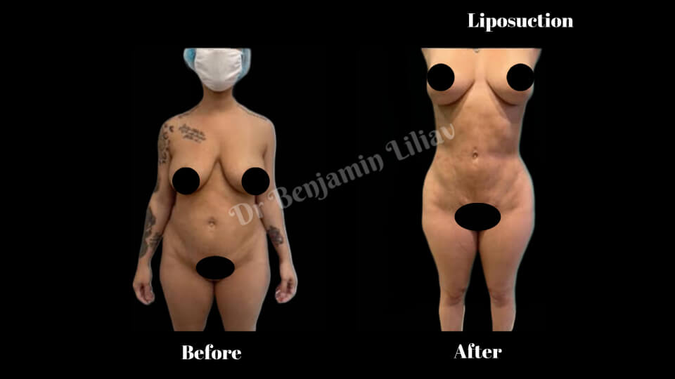 Case--7680 | Before and After Liposuction