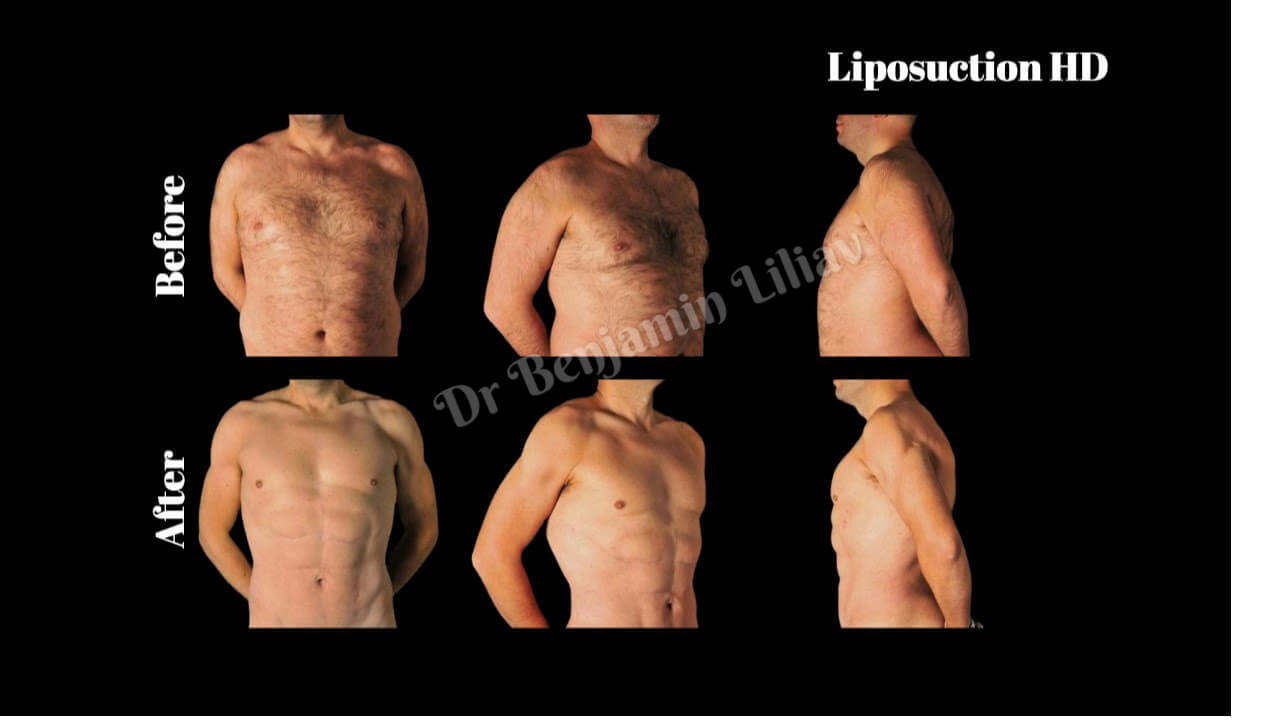 Case--7633 | Before and After Liposuction HD
