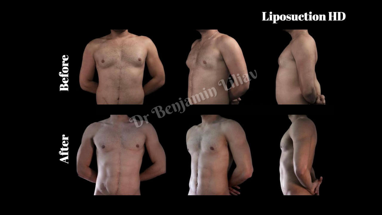 Case--4602 | Before and After Liposuction HD