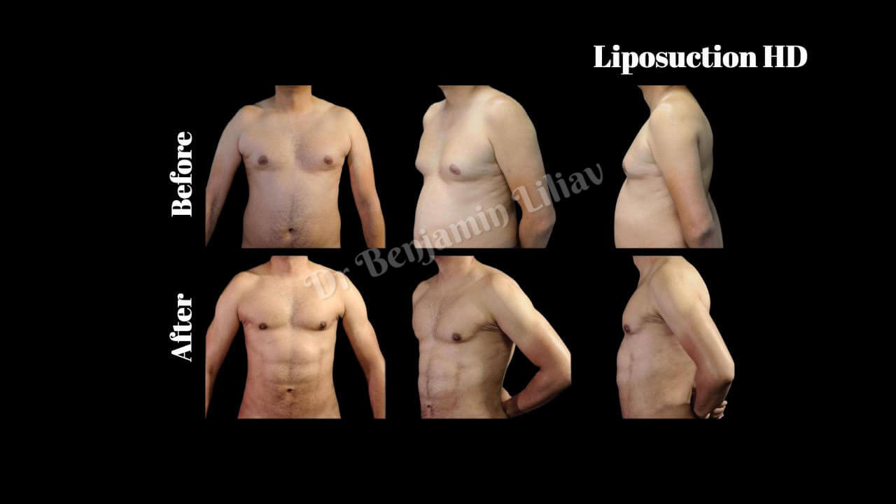 Case--8725 | Before and After Liposuction HD
